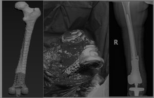 Issues of Knee Joint Endoprosthetics in Megadefects Cases: Opportunities and Challenges
